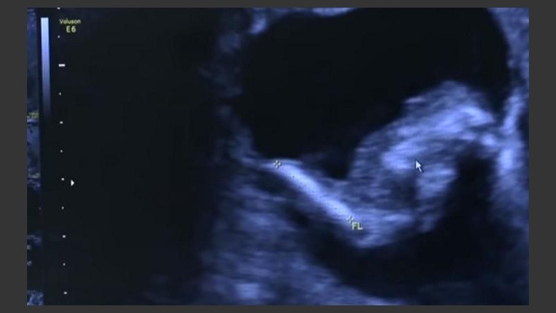 La ecografía descubrió la presencia de un feto en el cuerpo de la niña.