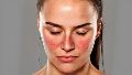 El sarpullido, principalmente en el rostro, es uno de los síntomas más habituales de esta enfermedad autoinmune.