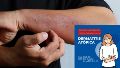 Dermatitis atópica: campaña nacional de detección gratuita