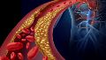Las enfermedades cardiovasculares son la principal causa de muerte global y suelen originarse en la aterosclerosis.