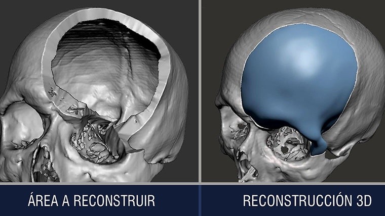 Reconstrucción 3D de cráneo